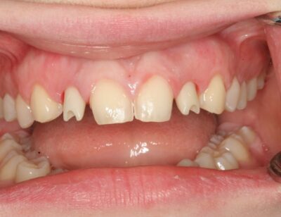 Congenitally missing teeth and misaligned teeth