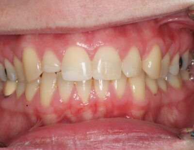 Bonded Emax Crowns